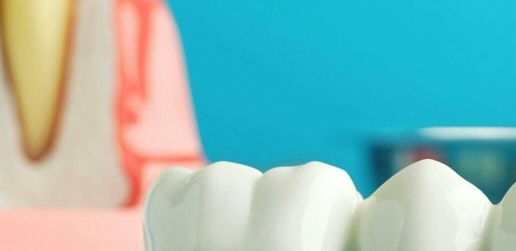 Dental Crown Procedure