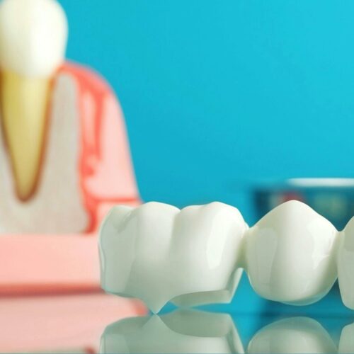 Dental Crown Procedure